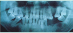Gum disease: X-ray showing teeth bone loss